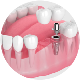 implant dentist Dubai