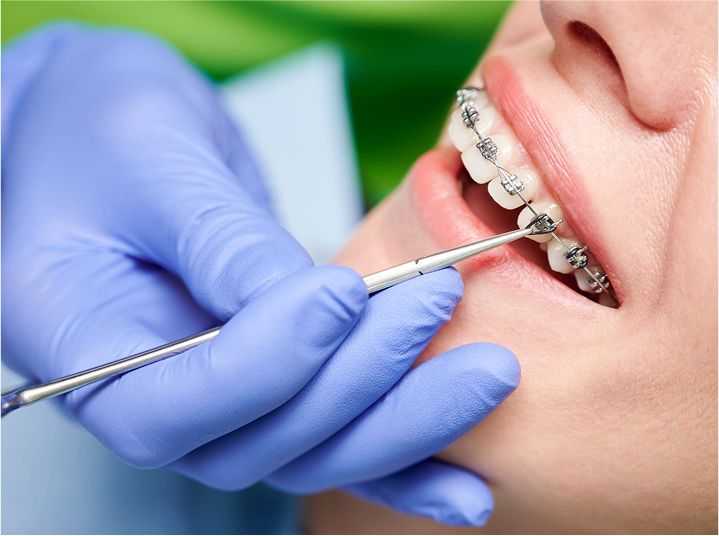 Orthodontic Extractions