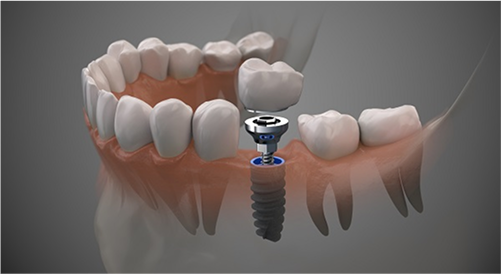 professional dental implants