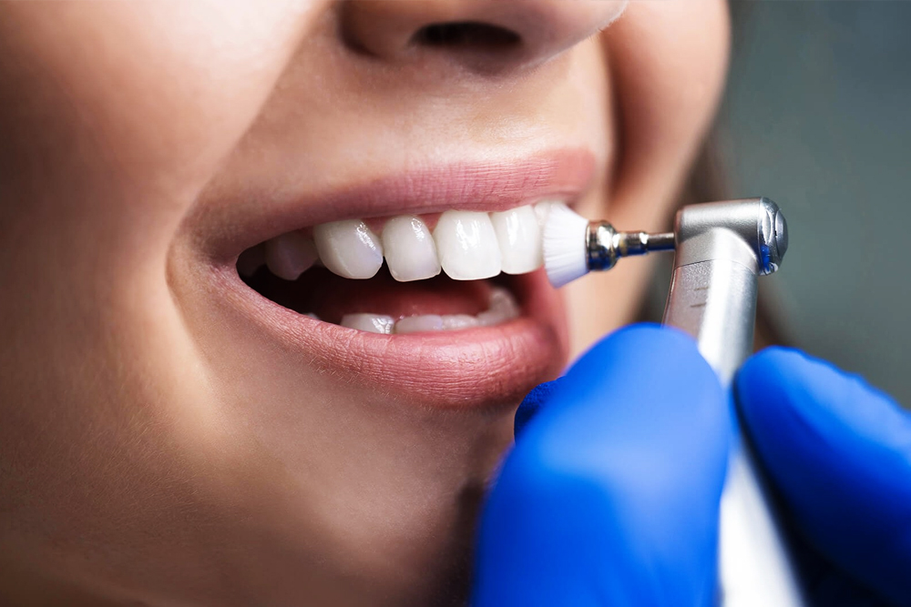 Scaling and Polishing